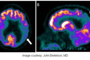Collaboration aimed at long-term Alzheimer’s genetics, biomarkers study